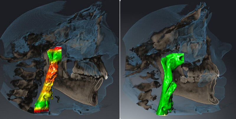 CBCT-derived 3D airflow simulation showing nasal airway resistance: red and yellow indicates highly restricted airflow on the left, after expansion the same airway shows uniform green indicating restored airflow
