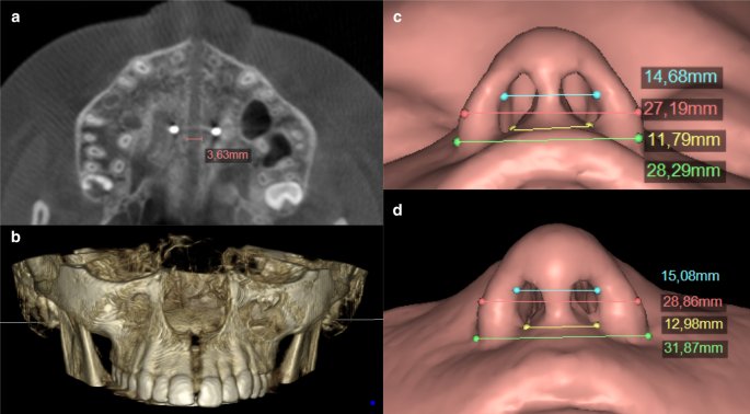 CBCT cone-beam CT axial slice and 3D reconstruction of the upper jaw and nasal cavity showing precise millimeter measurements of nasal valve width before and after airway expansion