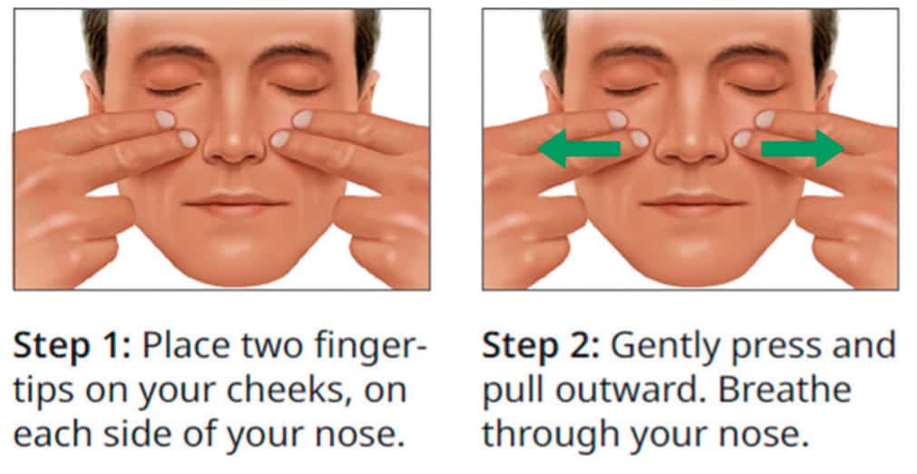 Cottle maneuver test diagram in two steps: place fingertips on cheeks beside the nose, then gently pull outward while breathing through the nose to assess nasal valve collapse