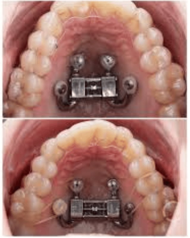 DOME ZERO palatal expander appliance bonded to upper molars before and after midpalatal suture expansion, showing visible widening of the upper arch and emerging diastema between the central incisors